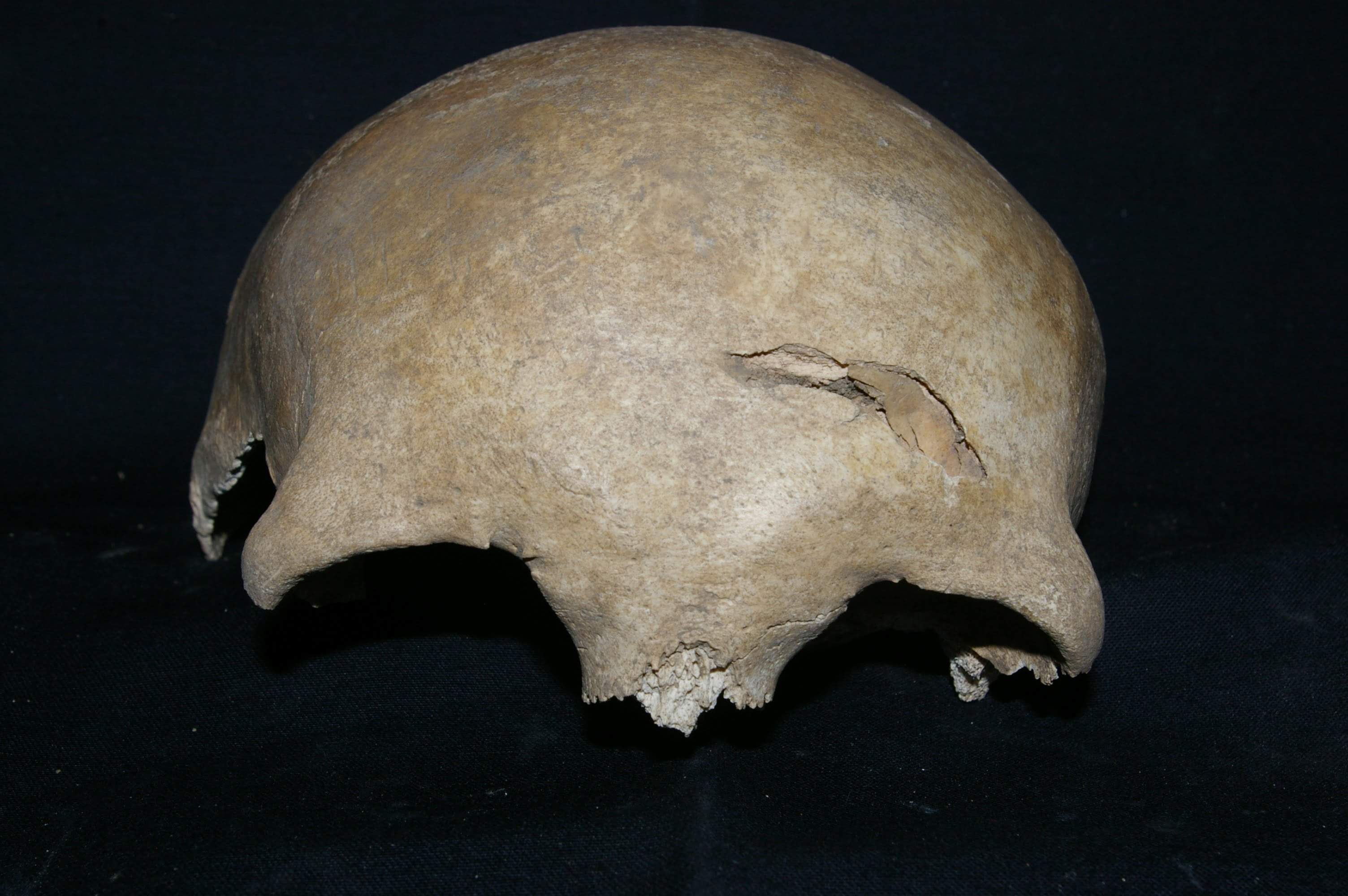 Złamanie z wgnieceniem na łusce kości czołowej - uraz powstały okołośmiertnie (perimortem) bez oznak gojenia - możliwa przyczyna zgonu - XVI wiek Bydgoszcz